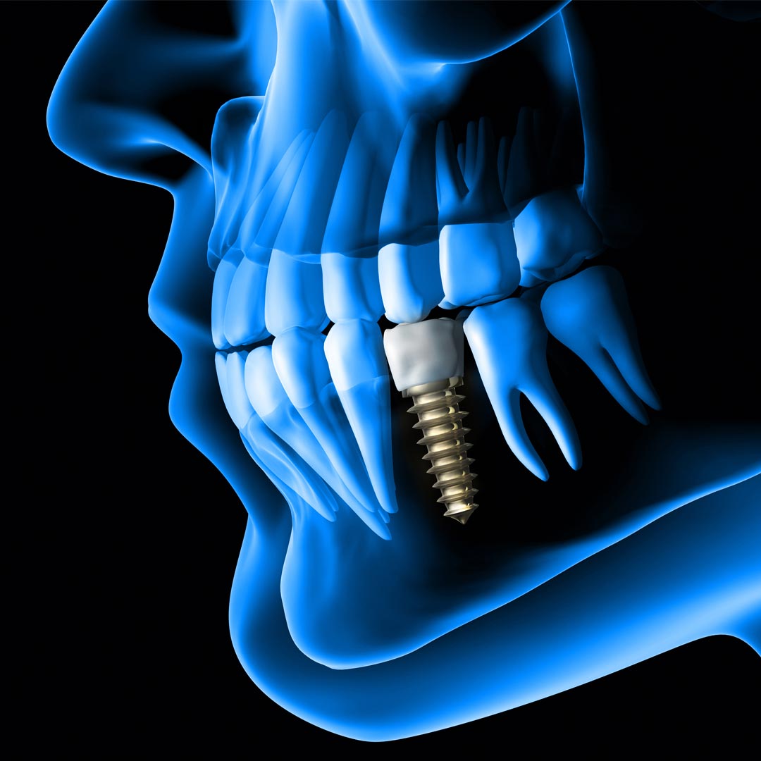 The Best Dental Implant Clinic in Dubai