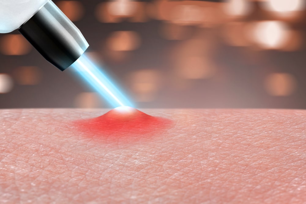 acne scar laser treatment