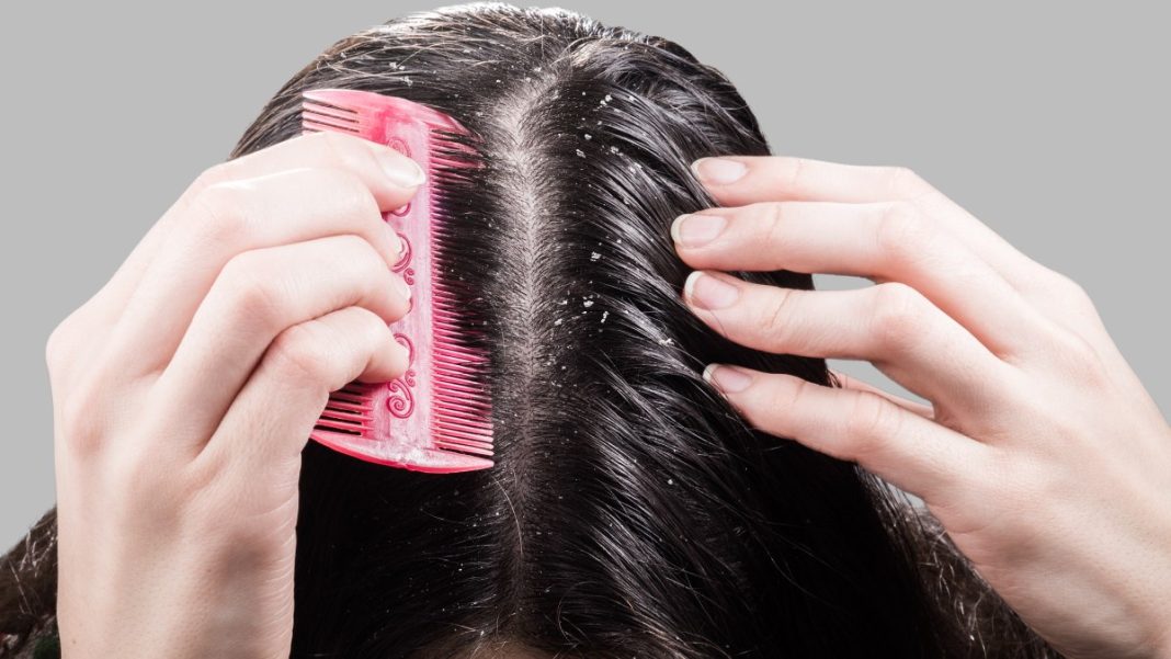 Really Bad Dandruff Shampoo - DailyTimeZone