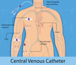 Ports-for-central-venous-catheters