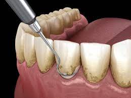 periodontitis treatment